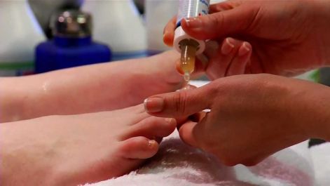 nail gomba kezelés calando tentorium körömgombától